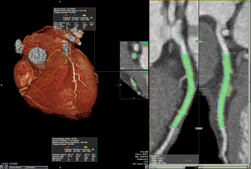Vitrea三維影像后處理軟件