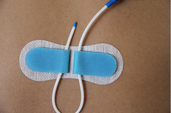 淄博創(chuàng)奇  導(dǎo)管固定裝置  PICC導(dǎo)管固定