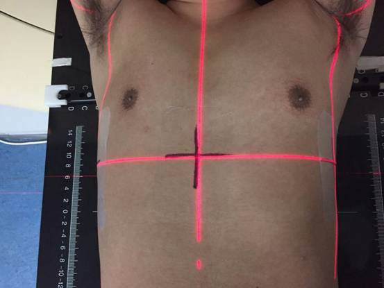 放療定位標(biāo)記線(xiàn)保護(hù)膜