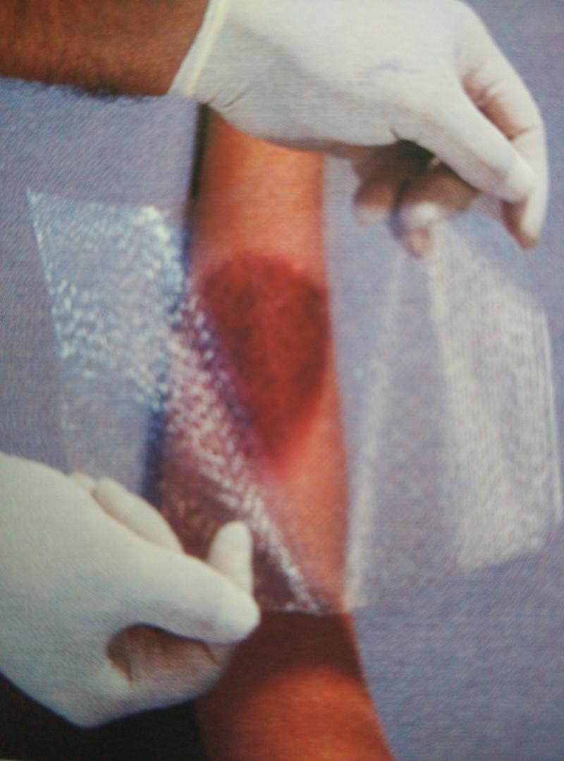 兒科傷口創(chuàng)面敷料