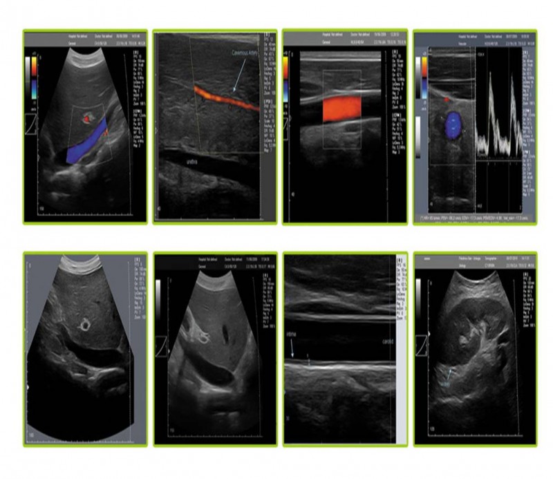超聲多普勒穿刺 PICC置管 超聲介入   靜脈置管