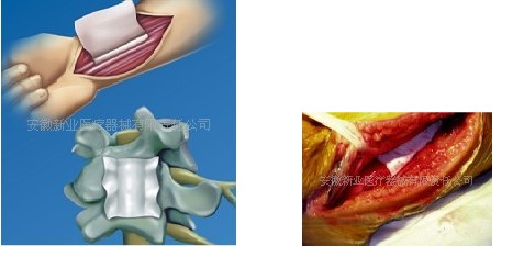 可吸收醫(yī)用膜（成都迪康）