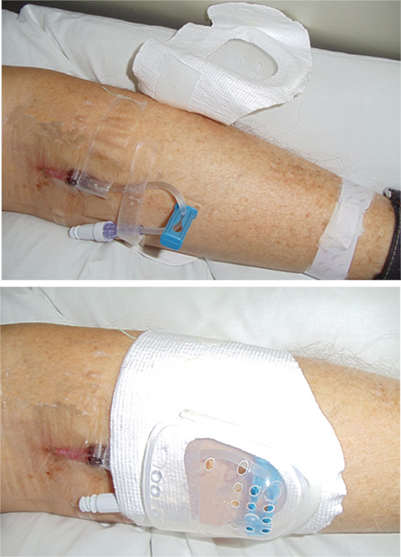 留置針輸液保護(hù)