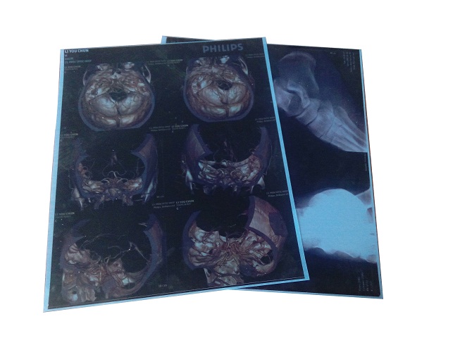 醫(yī)用藍(lán)光膠片