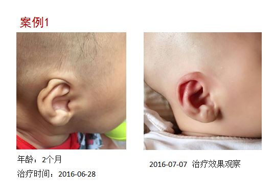 （靚耳）小兒耳廓矯形器