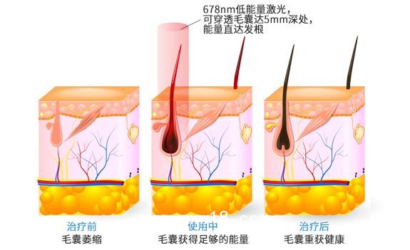 “艾博拉”半導體激光生發(fā)儀、全國招商代理、加盟