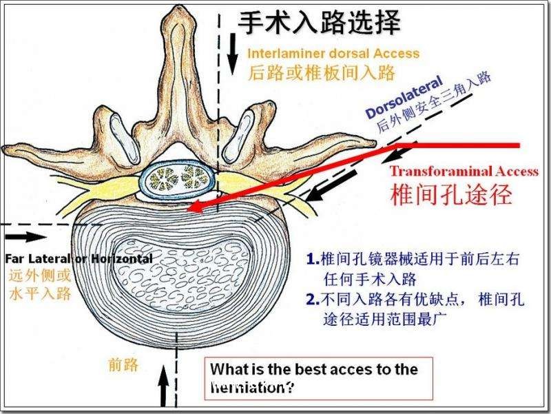 德國費(fèi)格椎間孔鏡技術(shù)
