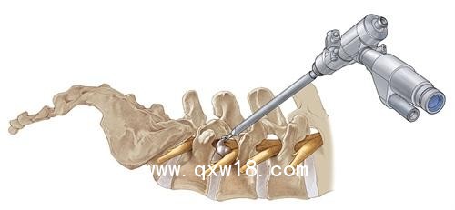 德國費(fèi)格椎間孔鏡技術(shù)