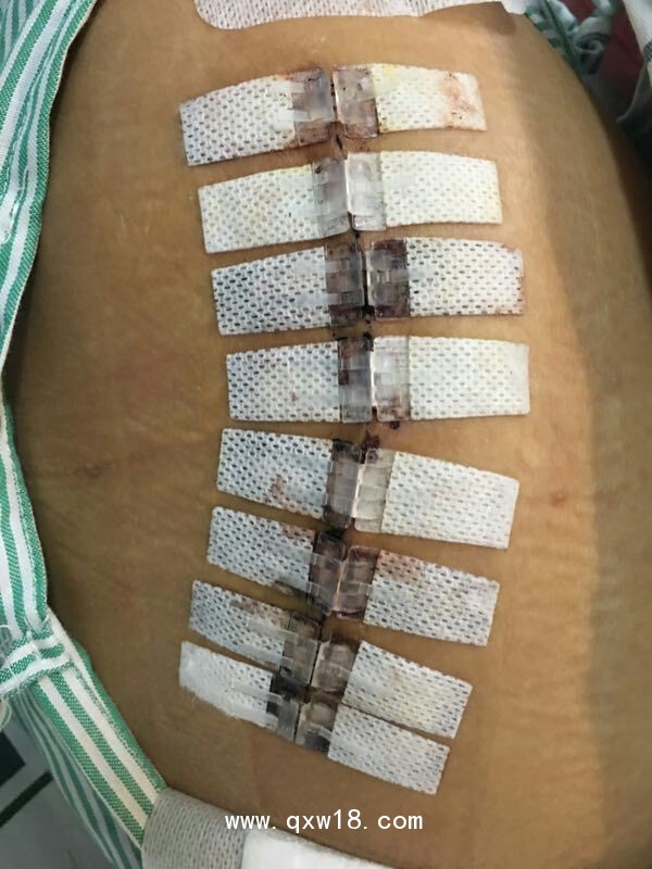 無(wú)針皮膚縫合器