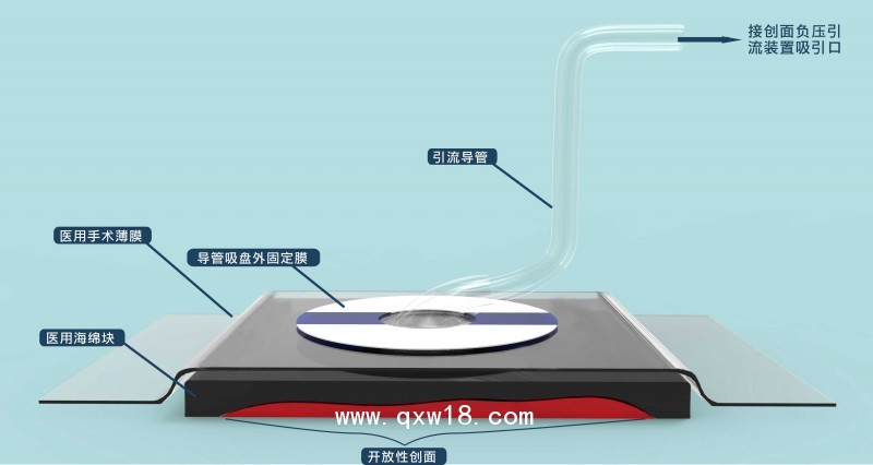 負壓封閉引流護創(chuàng)材料