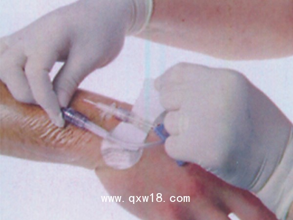 醫(yī)用導(dǎo)管夾 導(dǎo)管固定帖（置留針固定） A型中