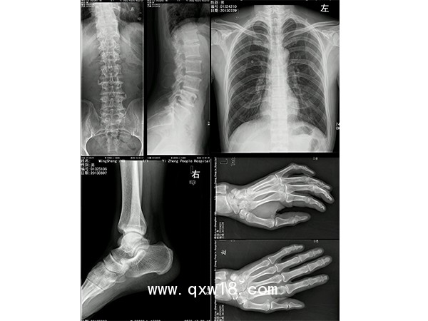 醫(yī)用干式膠片 醫(yī)用膠片 熱敏膠片 CT膠片 X光膠片