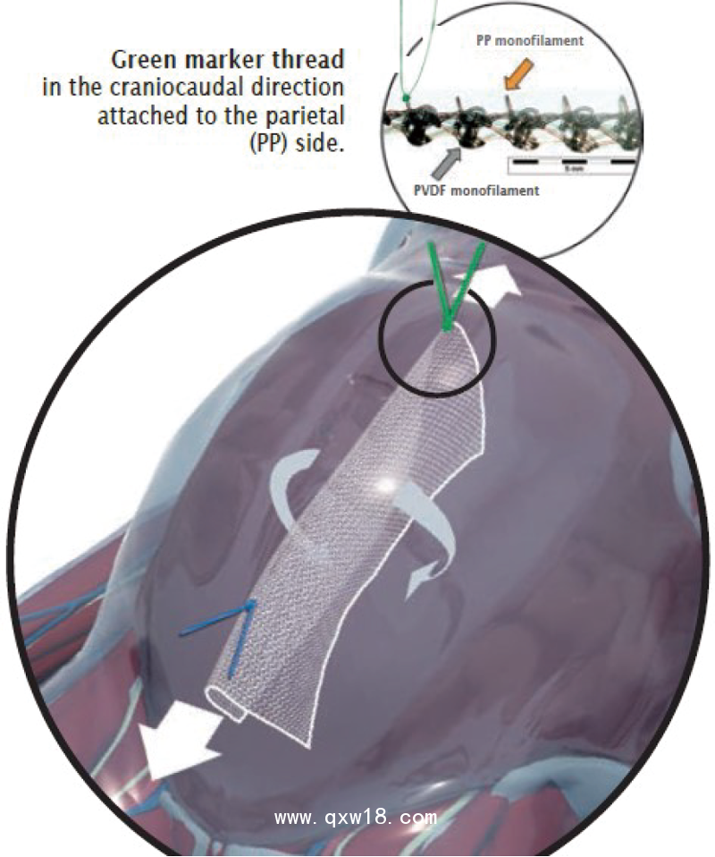 德國(guó)PVDF材質(zhì)疝氣補(bǔ)片-IPOM