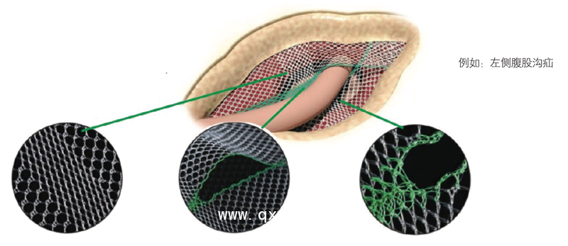 德國(guó)PVDF材質(zhì)疝氣補(bǔ)片-Lichtenstein