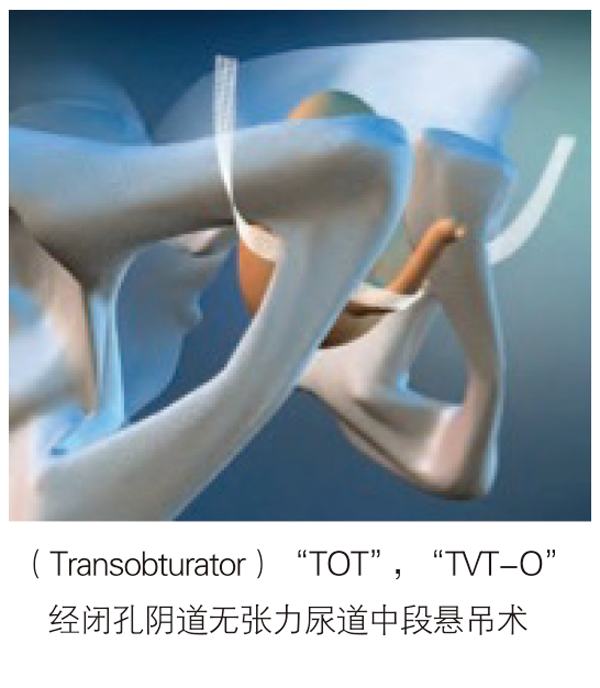 德國(guó)PVDF材質(zhì)尿失禁吊帶-SIS/SIS direct