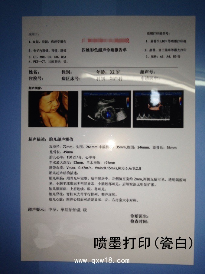 瓷白A4胃腸鏡病理B超四維彩超醫(yī)用打印膠片