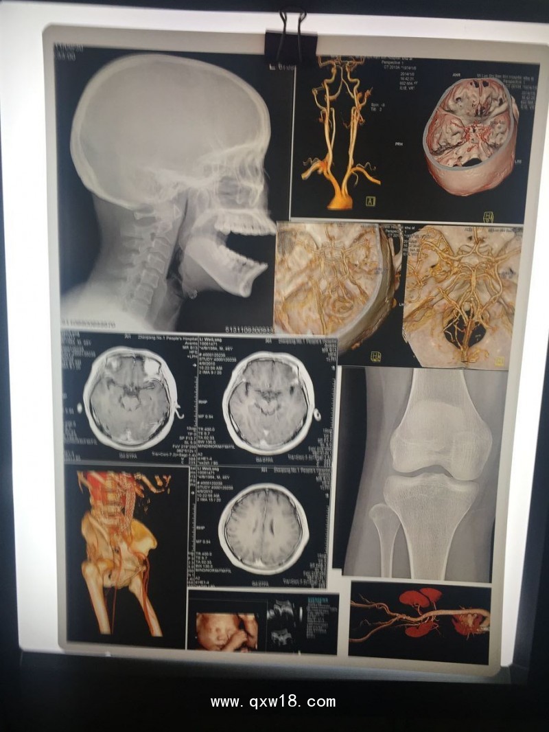 瓷白A4胃腸鏡病理B超四維彩超醫(yī)用打印膠片
