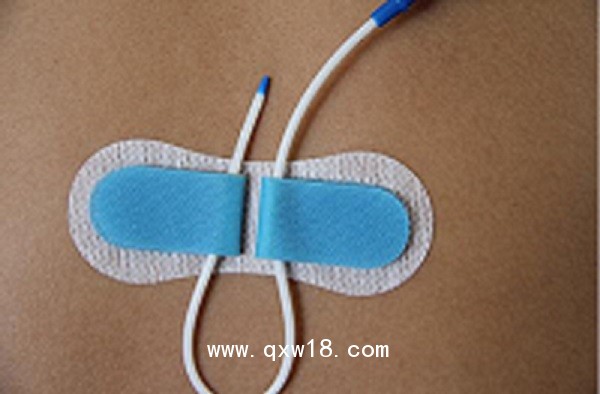 一次性導管固定裝置（留置針延長管、硬膜外固定裝置）