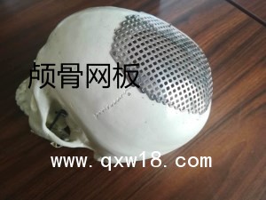 神經外科腦外科手術器械鈦網顱骨網板連接片