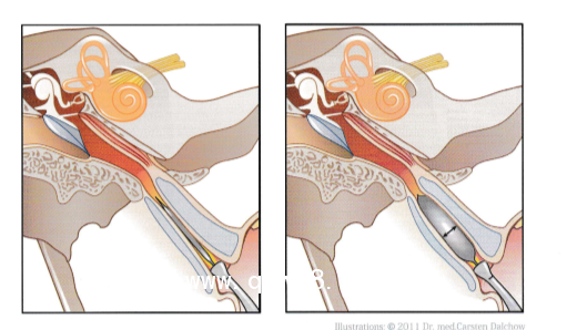 德國球囊擴張導管