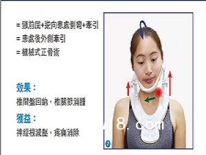 移動頸椎牽引器