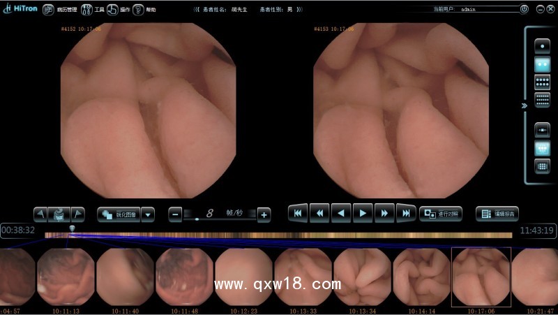 供應(yīng)Hitron膠囊內(nèi)鏡 膠囊內(nèi)窺鏡 膠囊式內(nèi)窺鏡系統(tǒng)