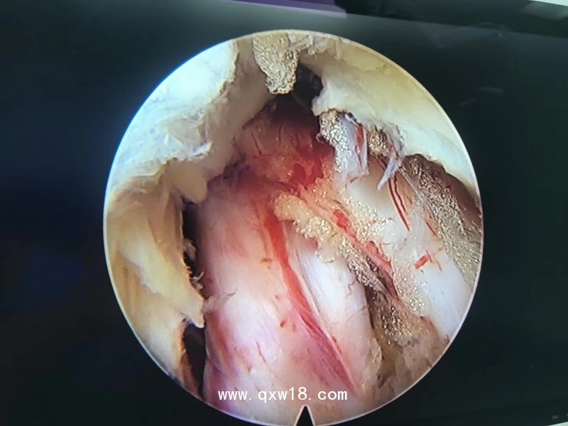 椎間孔鏡生產(chǎn)廠家德國進(jìn)口椎間孔鏡全國總代理