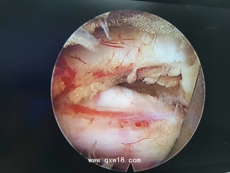 椎間孔鏡生產(chǎn)廠家德國進(jìn)口椎間孔鏡全國總代理