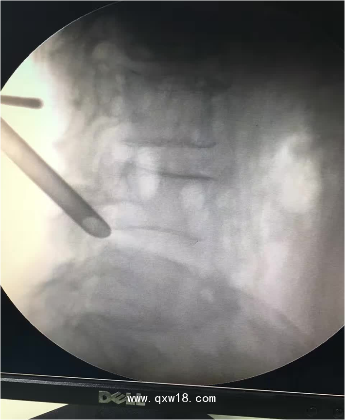 椎間孔鏡品牌椎間孔鏡椎間孔鏡技術(shù)椎間孔鏡培訓(xùn)