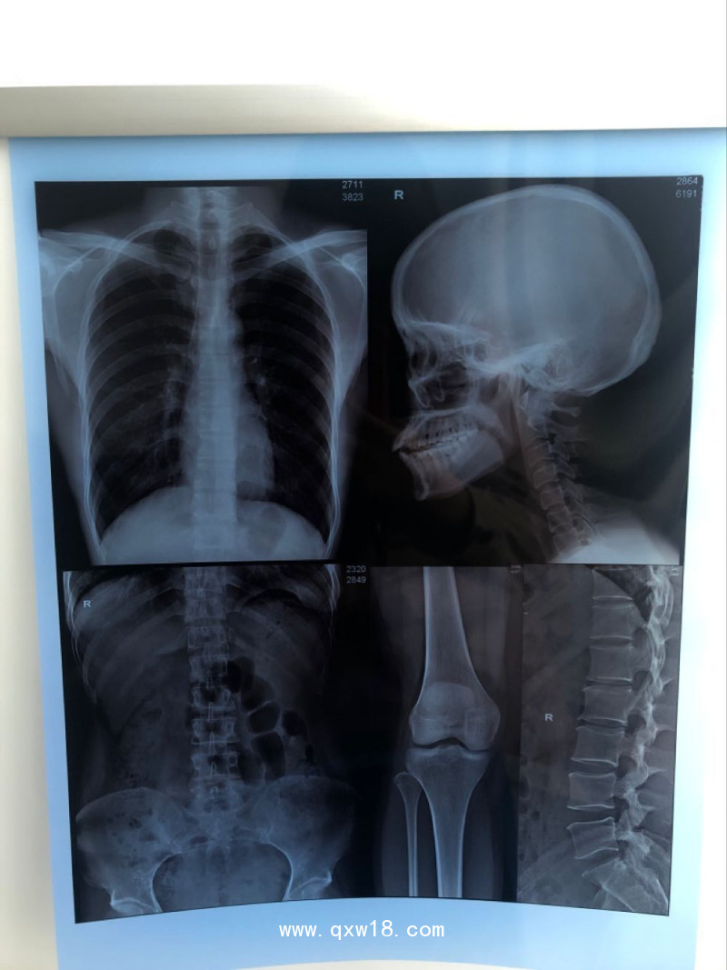 【奧格西】噴墨放射藍(lán)片醫(yī)用膠片