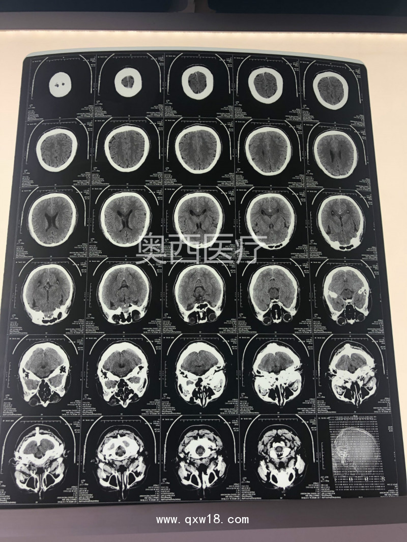 【奧格西】醫(yī)用干式進口熱敏膠片（可提供自助取片機））