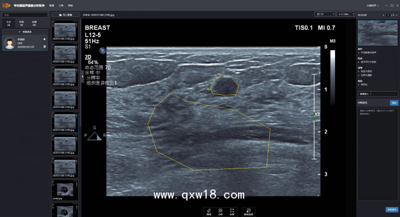 超聲影像輔助診斷系統(tǒng)