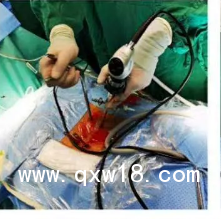 UBE器械、UBE技術(shù)