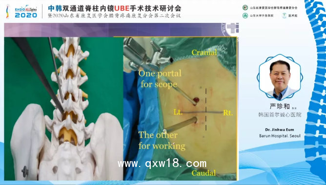 UBE全套脊柱手術器械 BESS/UBE全脊柱內(nèi)窺鏡手術器械