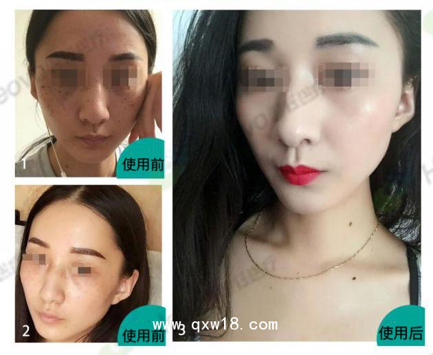 美拉美尚干細胞外泌體液體敷料