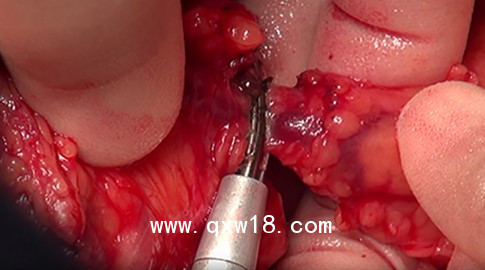 強生超聲刀頭har9f 甲狀腺刀頭 乳腺刀頭