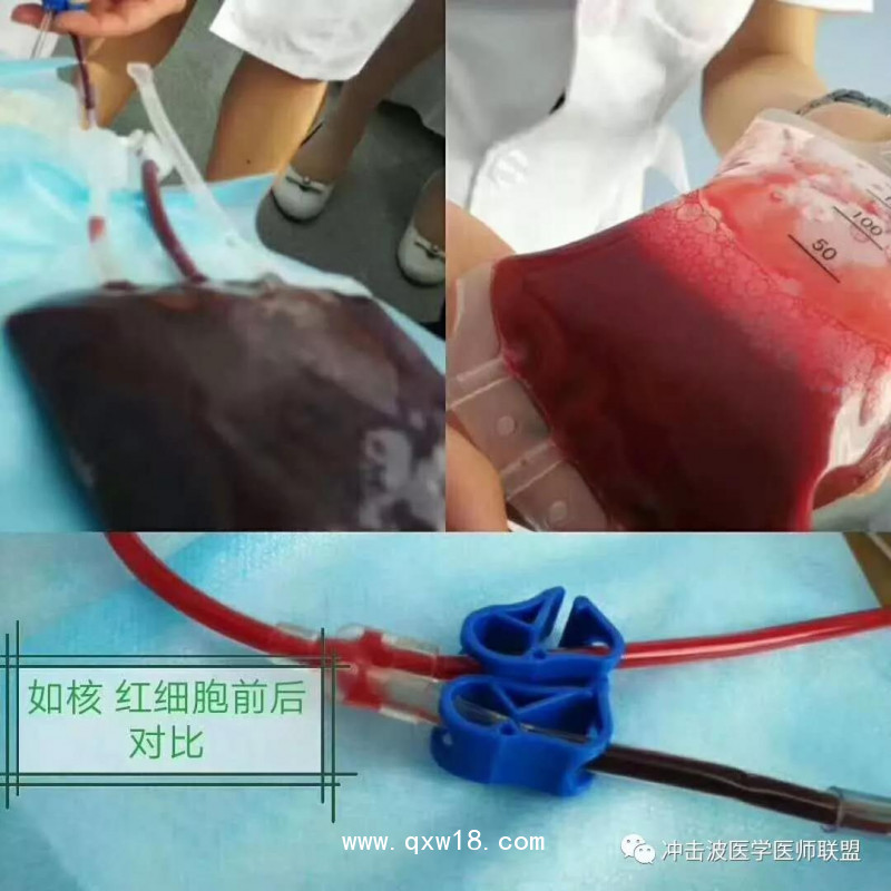 臭氧自體血血袋、三氧自體血血袋、一次性血袋