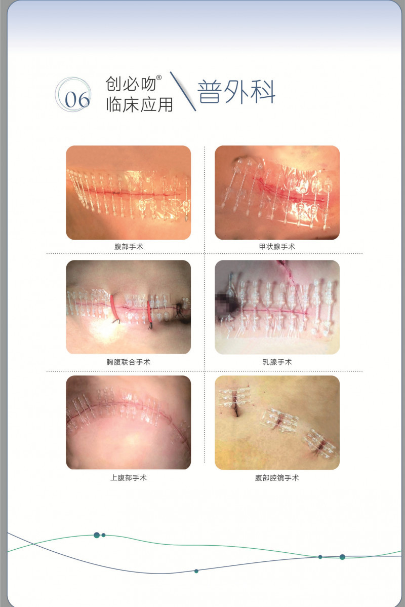 無(wú)創(chuàng)皮膚吻合器縫合器