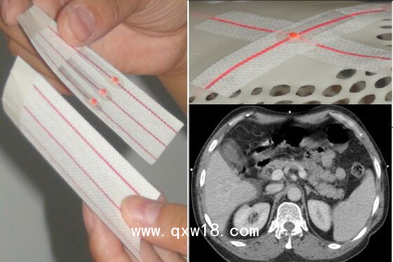 醫(yī)學圖像體外定位貼（MK-RT型，MK-CT型）