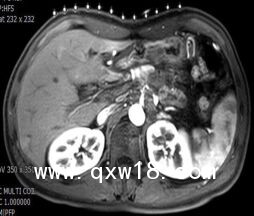 醫(yī)學(xué)圖像體外定位貼（MK#MR型，MR引導(dǎo)定位柵）