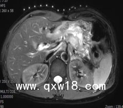 醫(yī)學(xué)圖像體外定位貼（MK#MR型，MR引導(dǎo)定位柵）