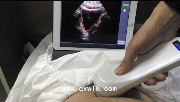 SONOSTAR四維掃描無線探頭式膀胱儀