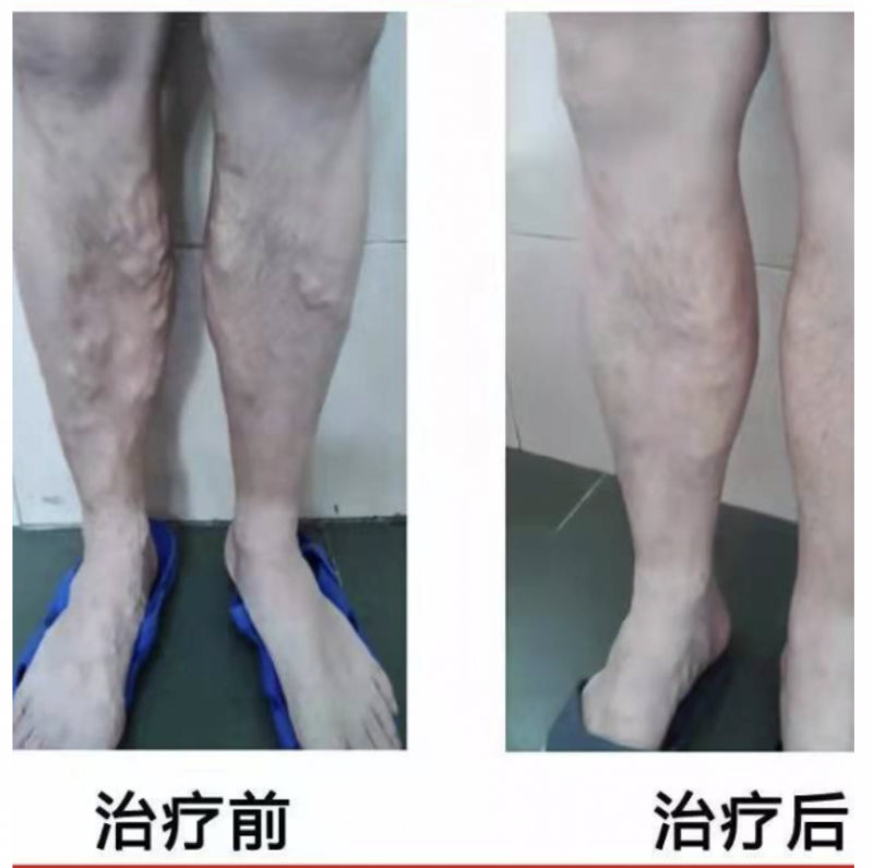 一次性微波消融導(dǎo)管 德文