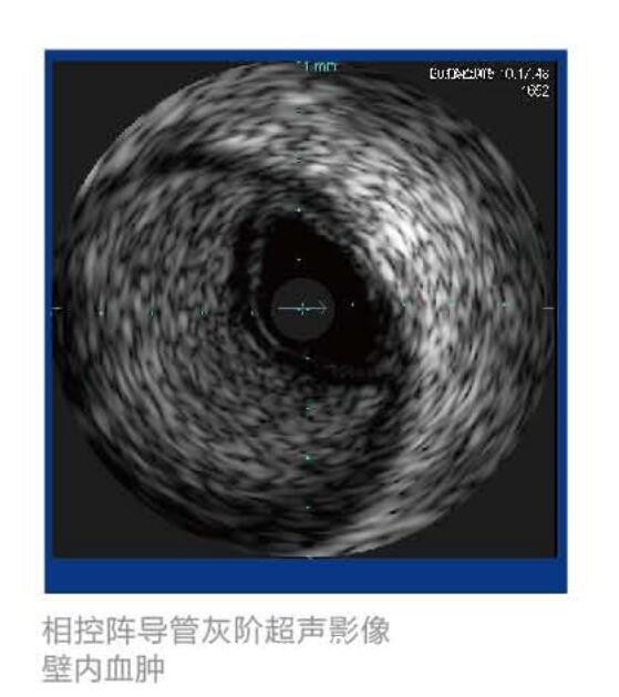 美國(guó)VOLCANO血管內(nèi)超聲波診斷儀 S5