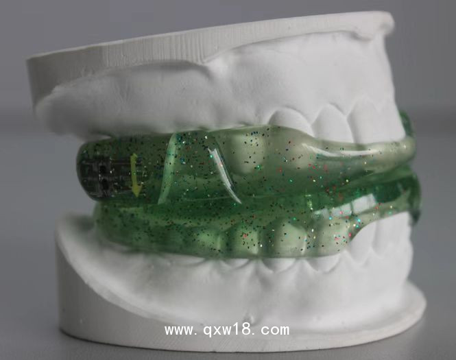 止鼾器（口內矯正器）