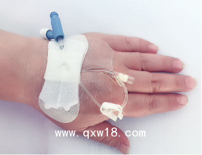 體表導(dǎo)管固定器