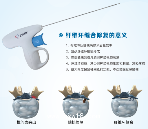 一次性使用纖維環(huán)縫合器市場推廣