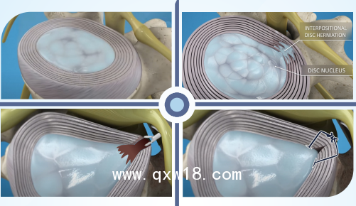 椎間孔鏡手術(shù)專用帶量耗材纖維環(huán)縫合器