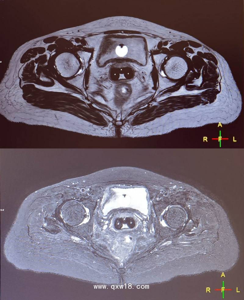 三維后裝CT/MR施源器MR成像標記線（醫(yī)學圖像標記定位貼）