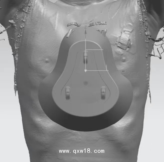 漏斗胸矯正器，負壓吸盤